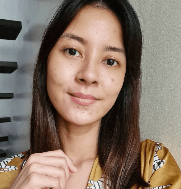 Bianca Gonzalez: ‘To anyone suffering from acne, know you are not alone’